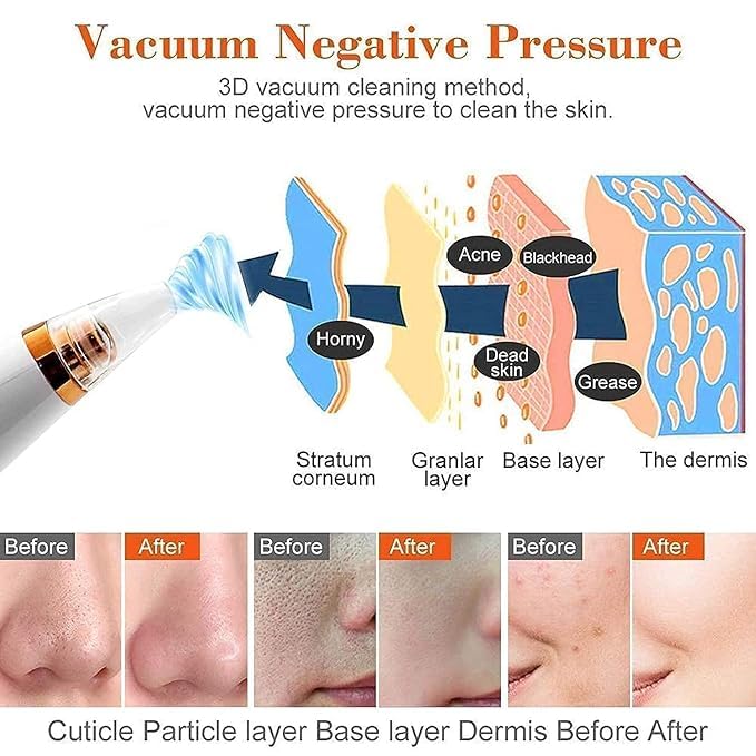 6-in-1 Blackhead Remover | USB Electric Facial Cleanser
